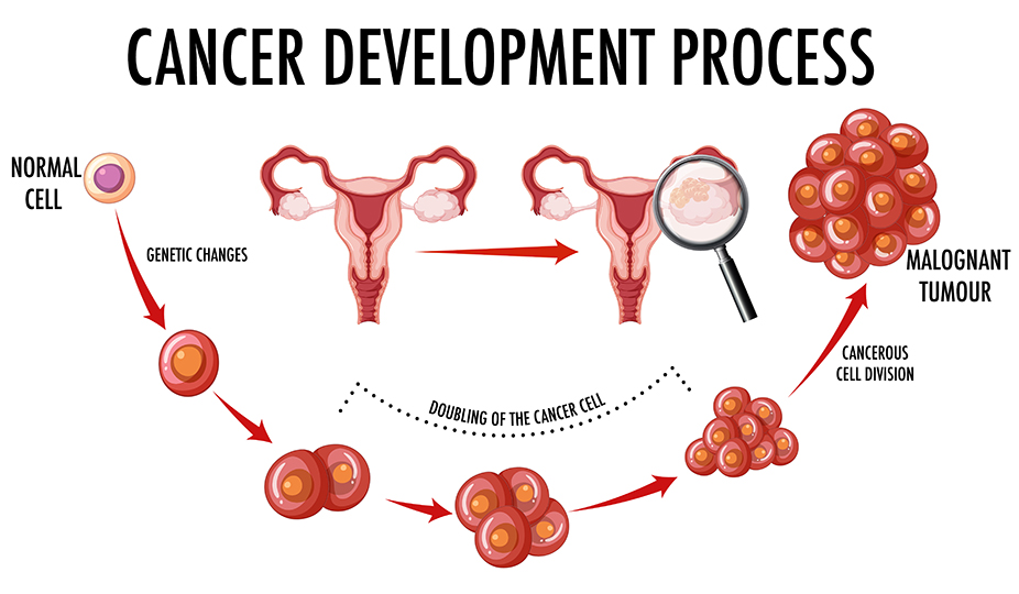 ovarian cancer development image