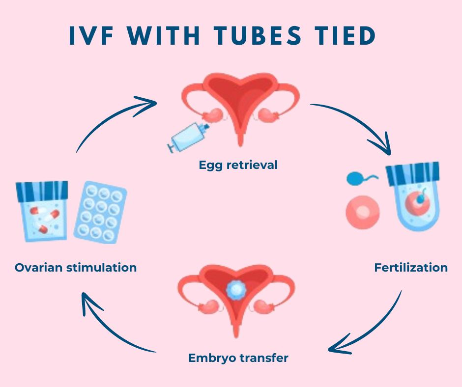 How to perform IVF with tied tubes