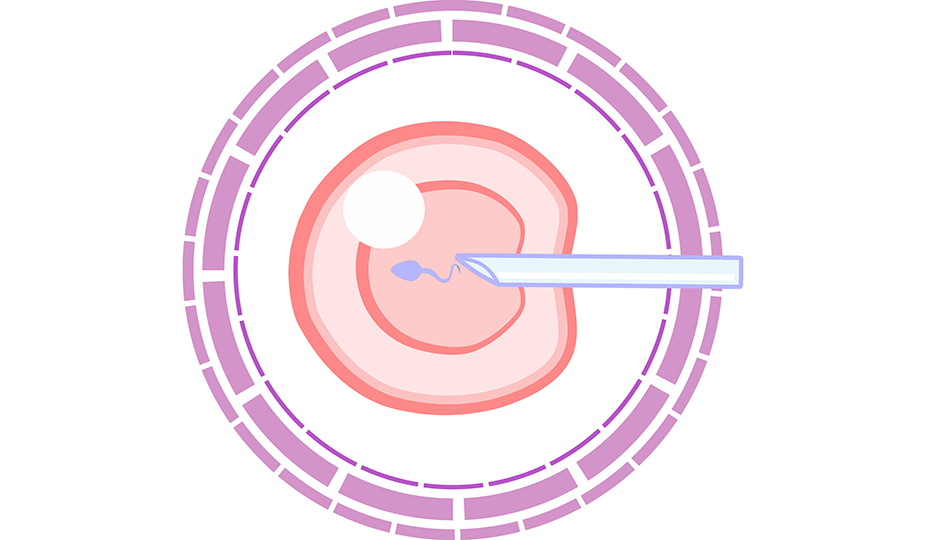 needle transports a sperm incide an oocyte with ICSI