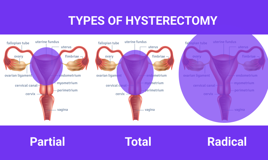 types of hysterectomy -  partial, total, and radical (infographics)